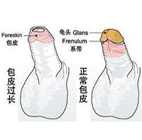 360°全面解析：包皮包茎