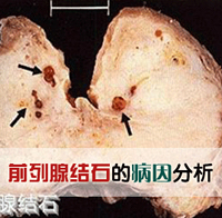 360°全面解析：前列腺结石